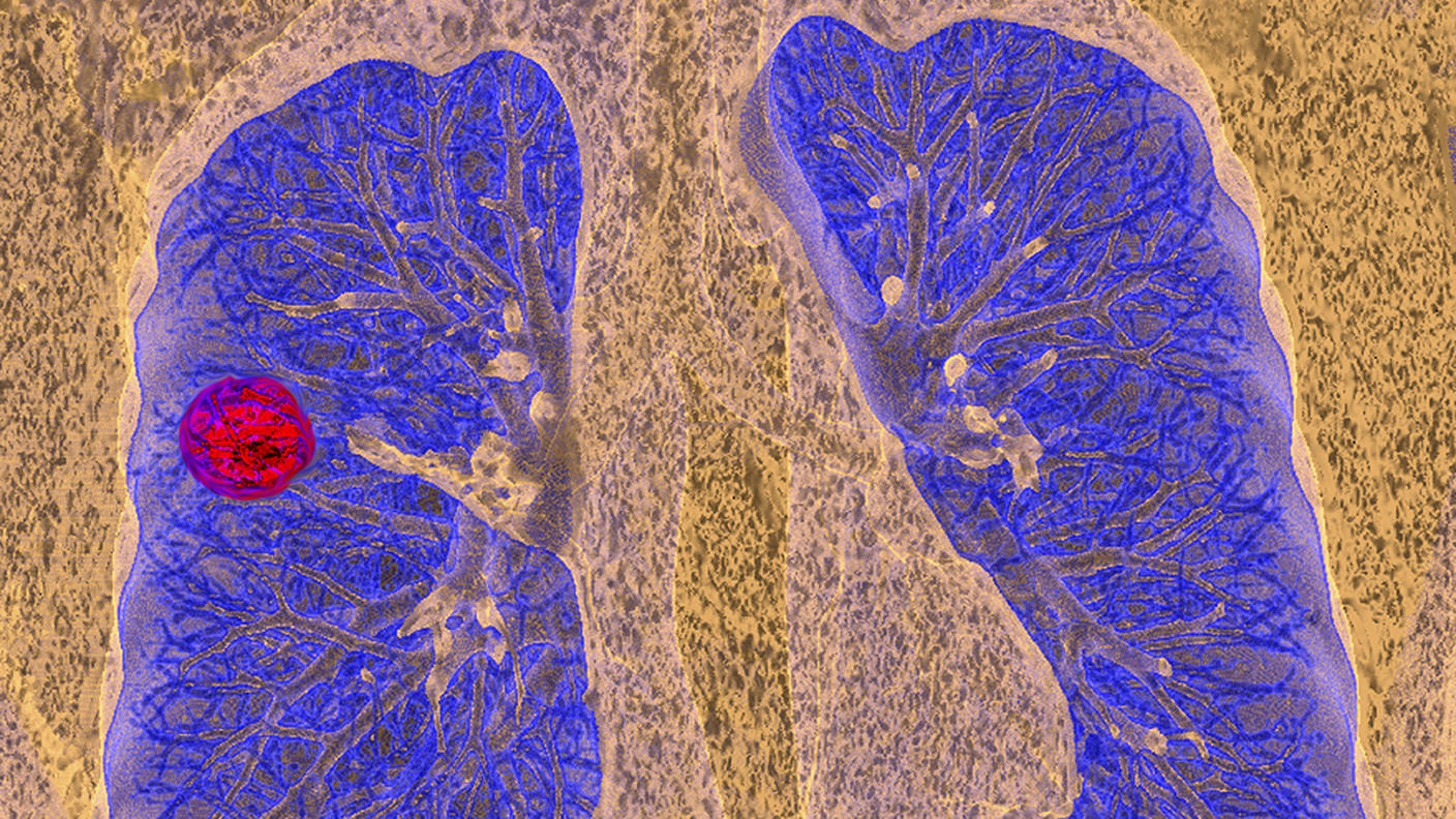 A CT scan of a person with lung cancer.