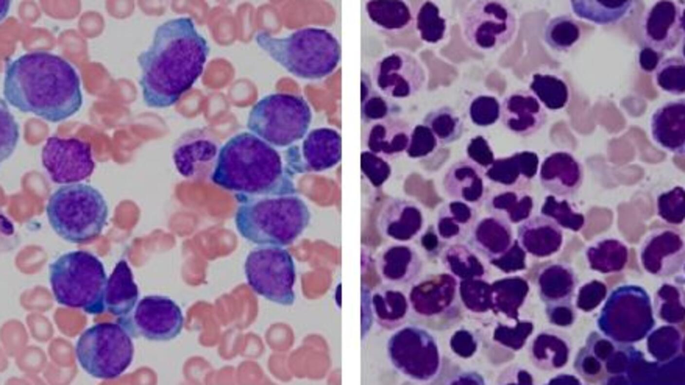Pathology slides from a patient with acute myeloid leukemia that has relapsed (left) and after remission (right).