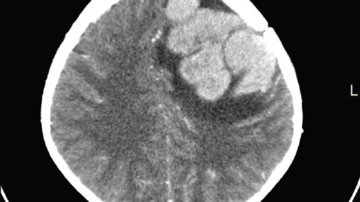A CT scan of a tumor recurrence in the brain of a child with ALL.