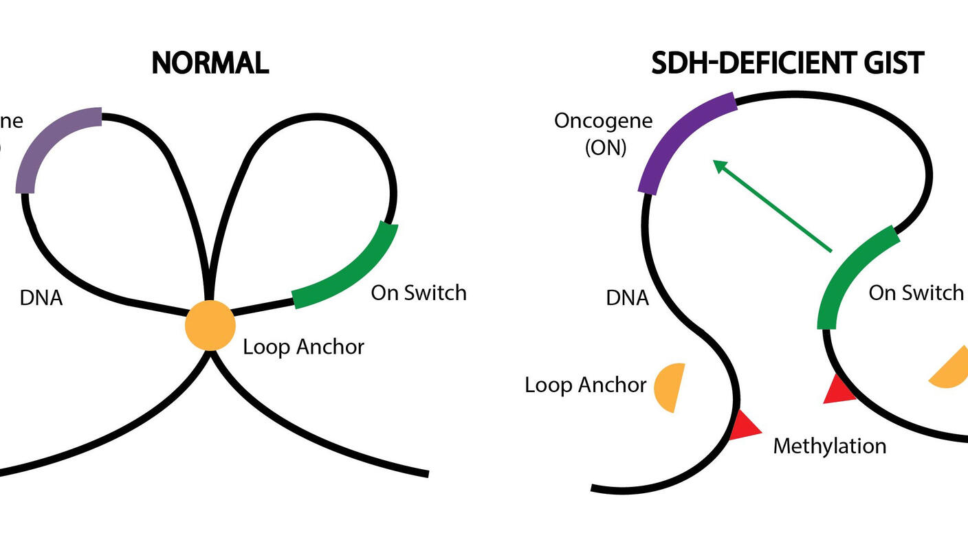 A graphic explaining epigenetic changes in normal cells and SDH-deficient GIST.