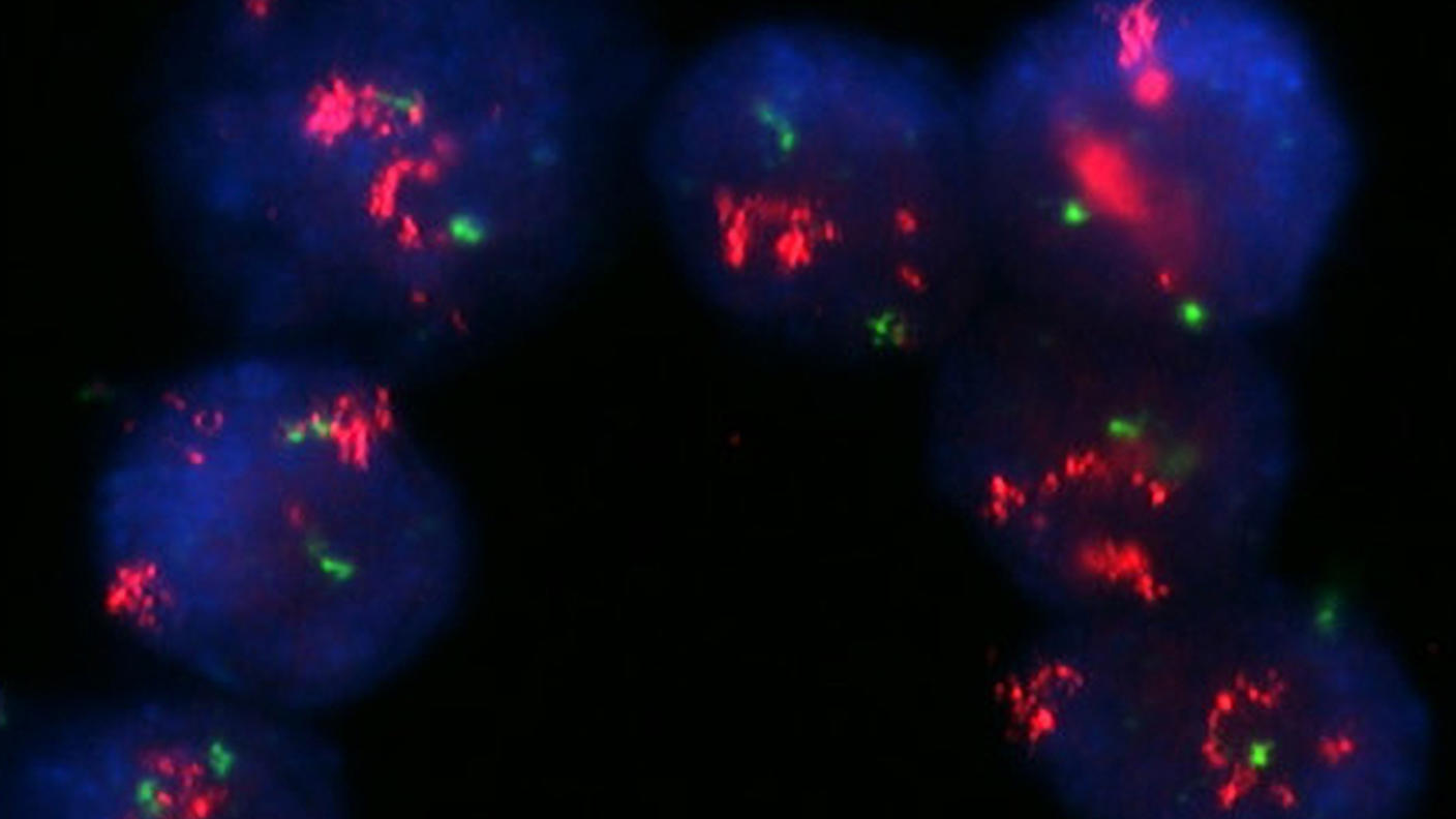 An image of breast cancer cells with strong HER2 amplification.