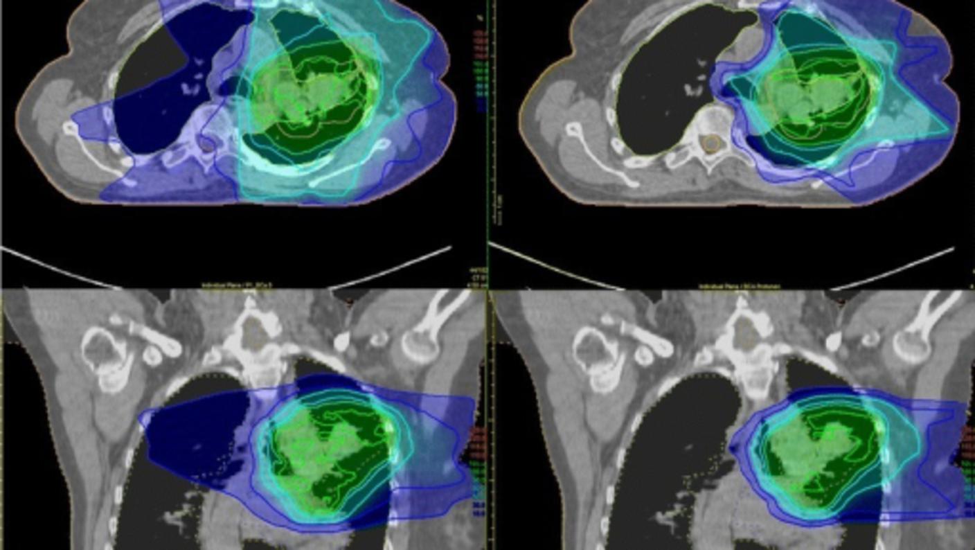 Scans of the chest after traditional radiation therapy and after proton therapy, which show how much surrounding tissue is affected by each type of therapy.