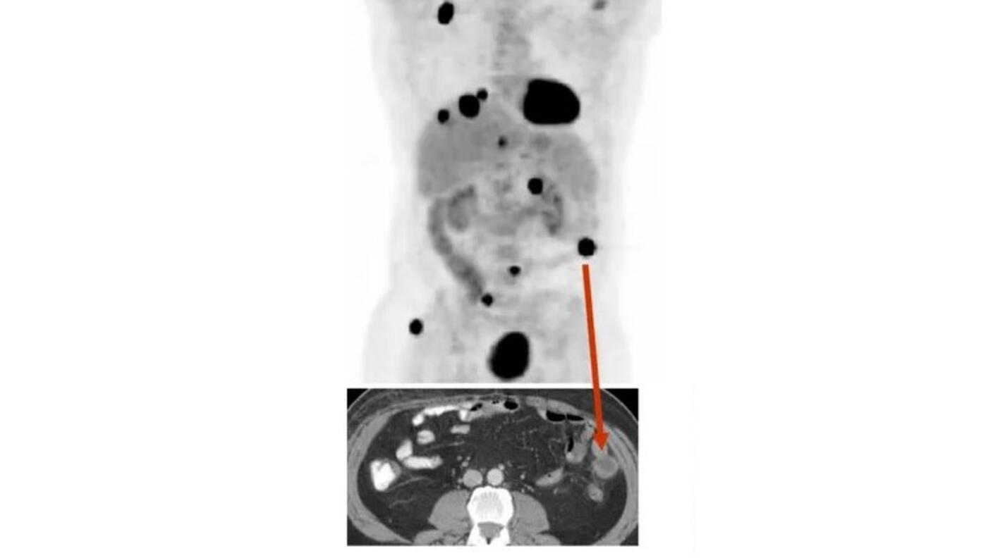 PET/CT scan of a patient with metastatic melanoma.