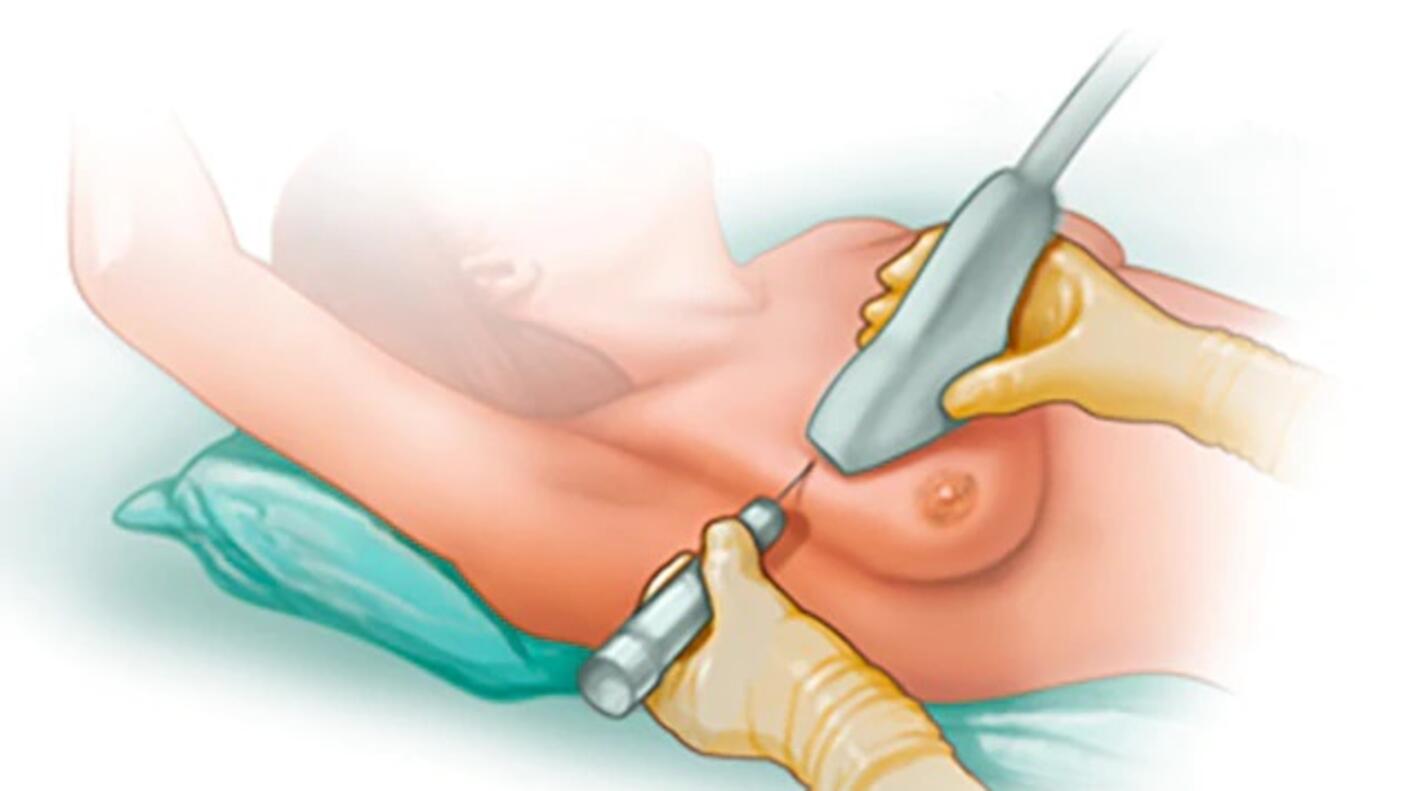 Illustration of a core needle biopsy of the breast.