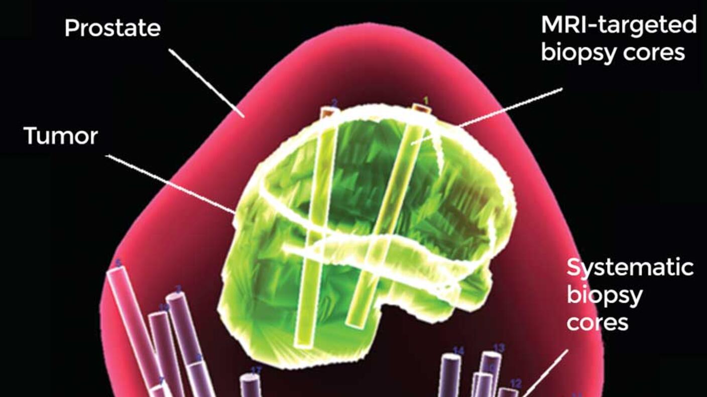 A 3-dimensional map of the prostate using combined MRI-targeted and systematic biopsies