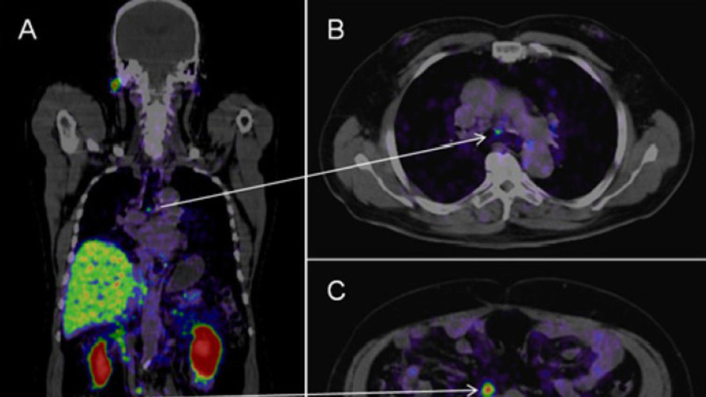 PSMA PET-CT images of a man with prostate cancer show metastases in lymph nodes in the chest and abdomen.
