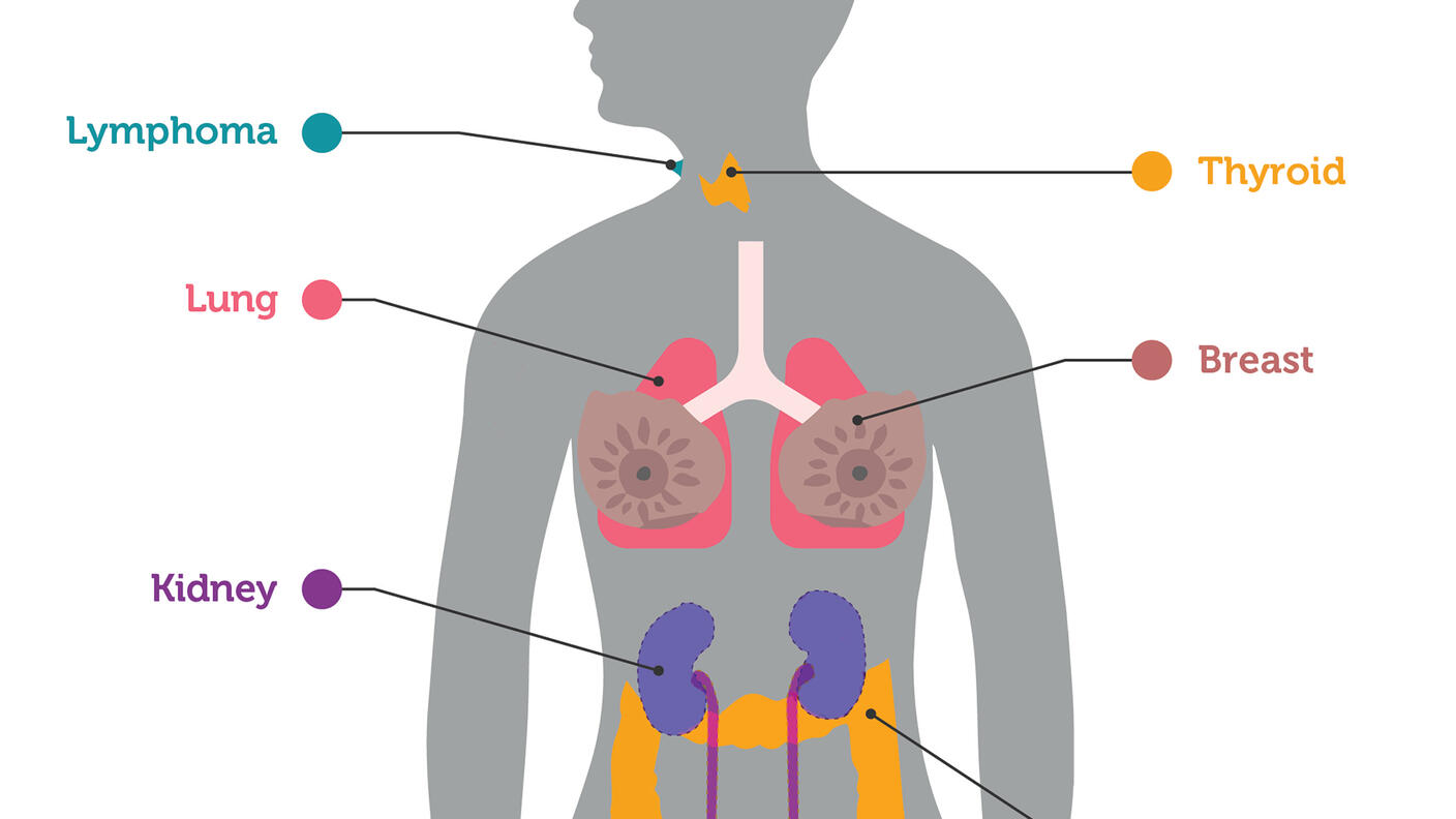 An illustration highlighting organs in which cancers were detected by an experimental blood test.