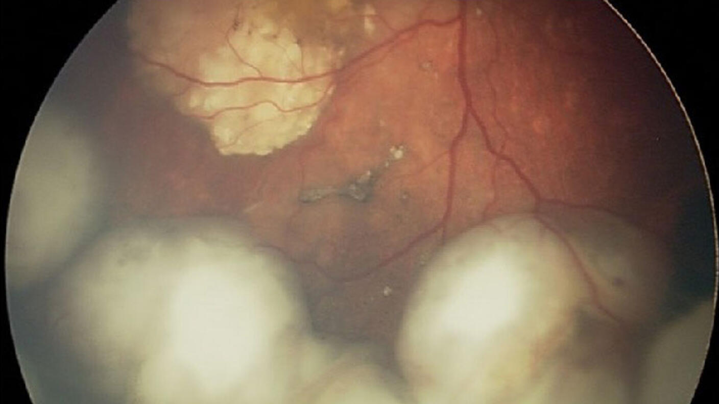 Fundoscopic exam revealing an intraocular retinoblastoma before treatment with intra-arterial chemotherapy