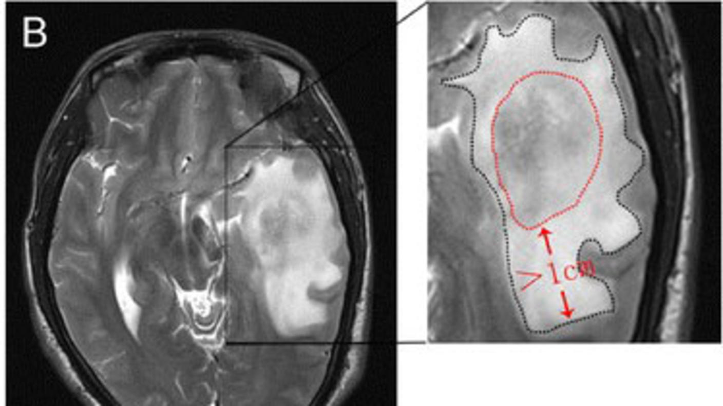 An MRI image of a brain tumor and swelling in the area around it.