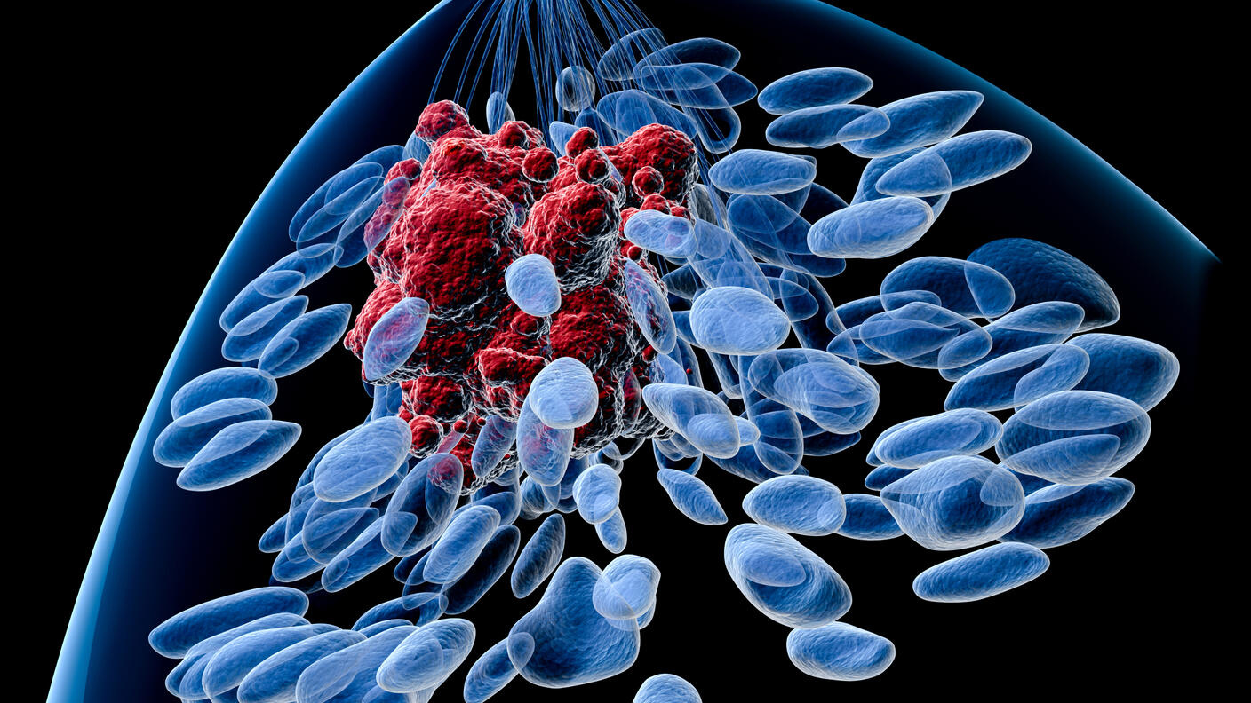 Top view of a female breast with a tumor. Inside of a blue body silhouette, lobules, lactiferous ducts (also blue) and a tumor (in red) can be seen. The background is black.