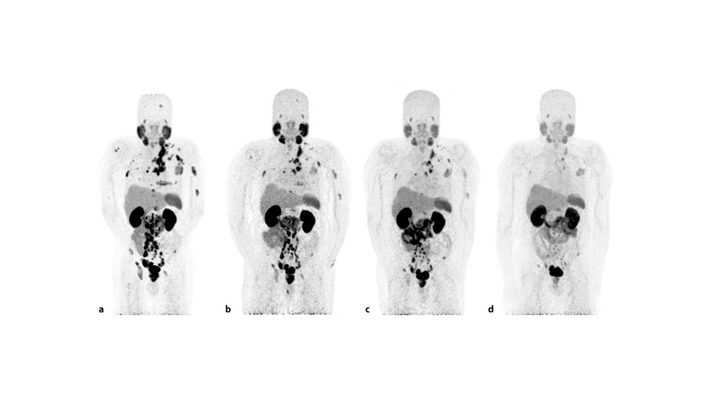 Serie de tomografía por emisión de positrones que muestran menos tumores después del tratamiento con Lu177-PSMA-617