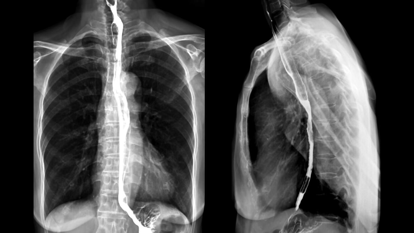X-ray highlighting the esophagus following a barium swallowing procedure.