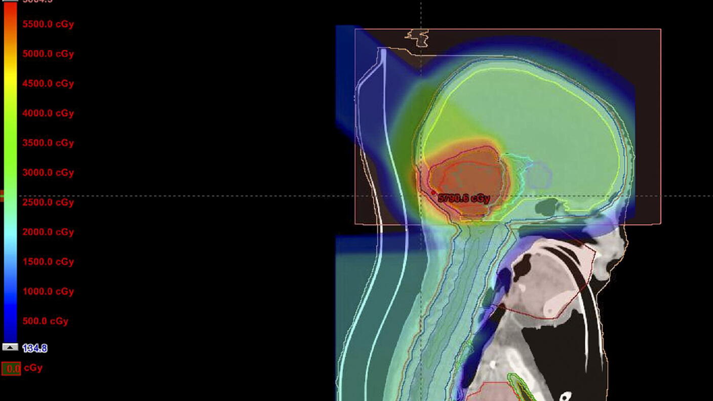 CT image of radiation plan for child with medulloblastoma