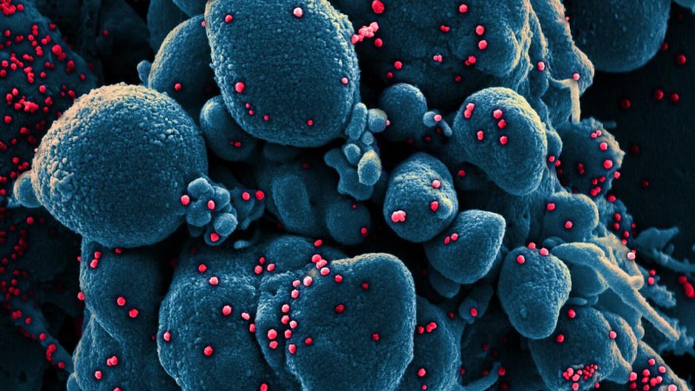 Cells infected with SARS-CoV-2 particles.