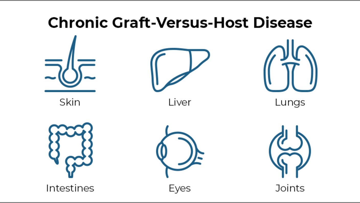 Text reading chronic graft-versus-host disease, followed by icons of six organs-skin, liver, lungs, intestines, eyes, and joints.