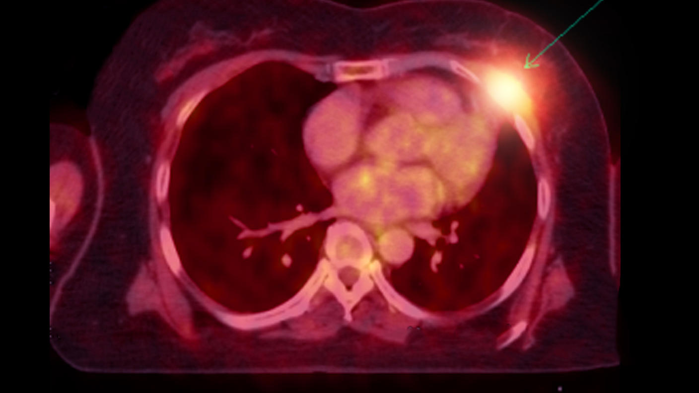 Tomografía por emisión de positrones con tomografía computarizada (TEP-TC) de un tumor que volvió en una persona con cáncer de pulmón.