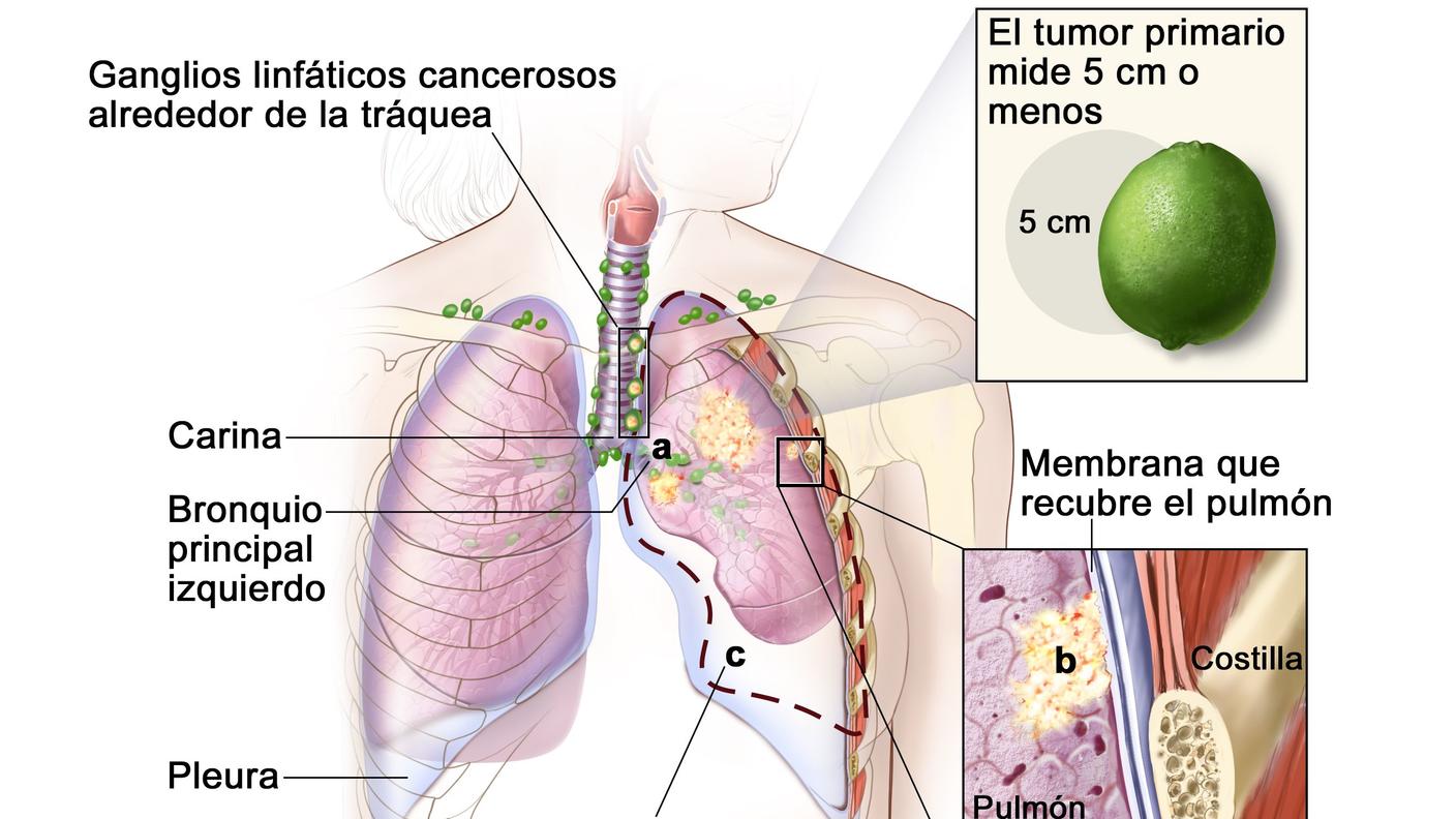En la imagen se observan un tumor primario que mide 5 cm o menos en el pulmón izquierdo y ganglios linfáticos cancerosos alrededor de la tráquea. También se observa que el cáncer se diseminó al bronquio principal izquierdo y a la membrana que recubre el pulmón.