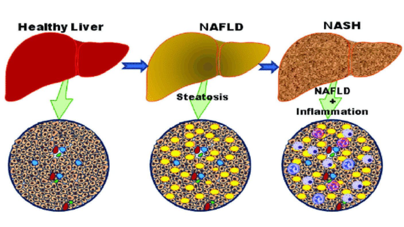 Illustration showing progression from normal liver to nonalcoholic steatohepatitis.