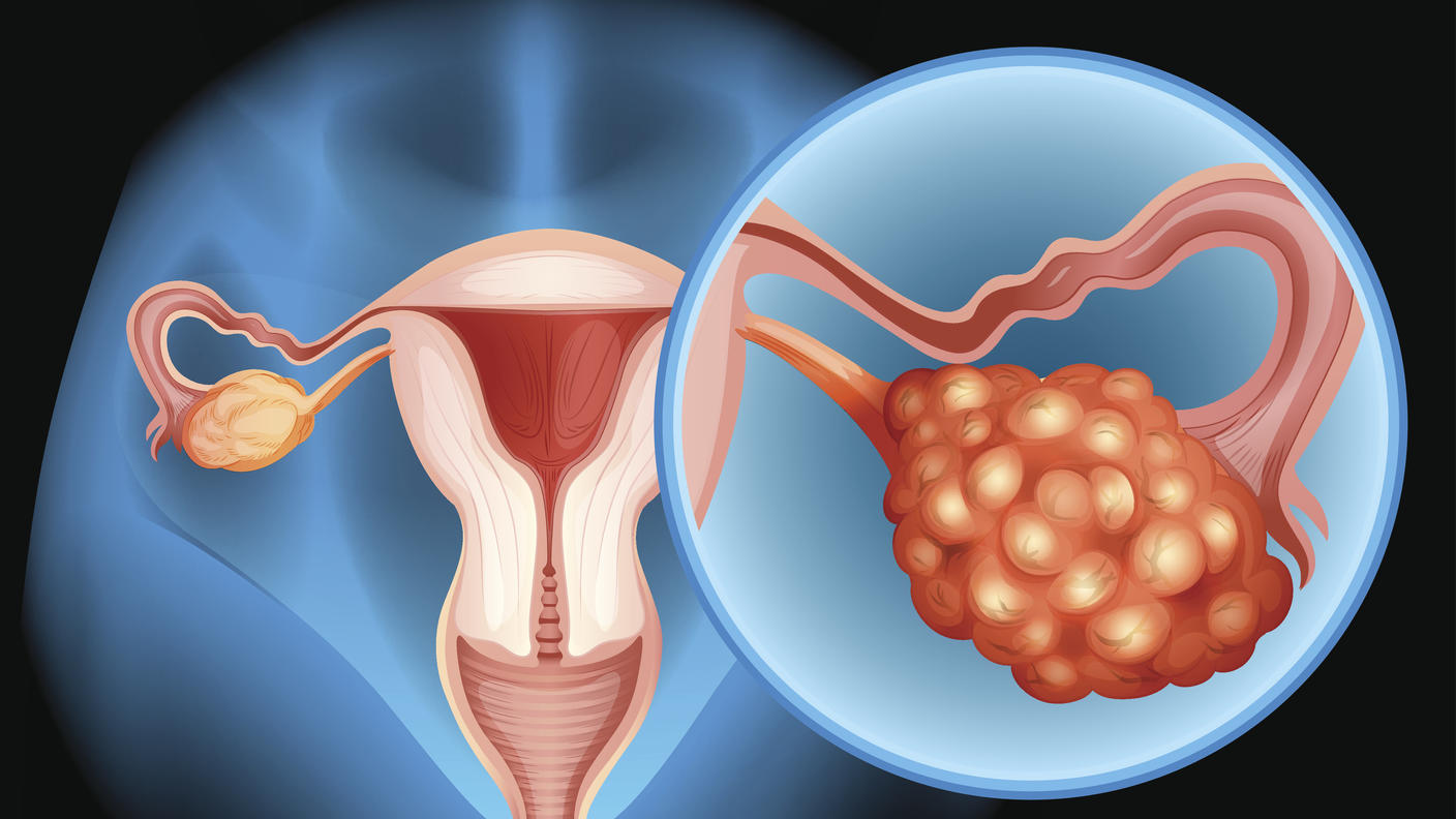 An illustration showing a tumor in an ovary.