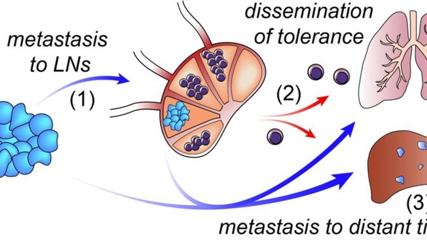 Graphic depicting tumor cells leaving the primary tumor and entering a lymph node. Immune cells leave the lymph node and enter the lungs and liver.