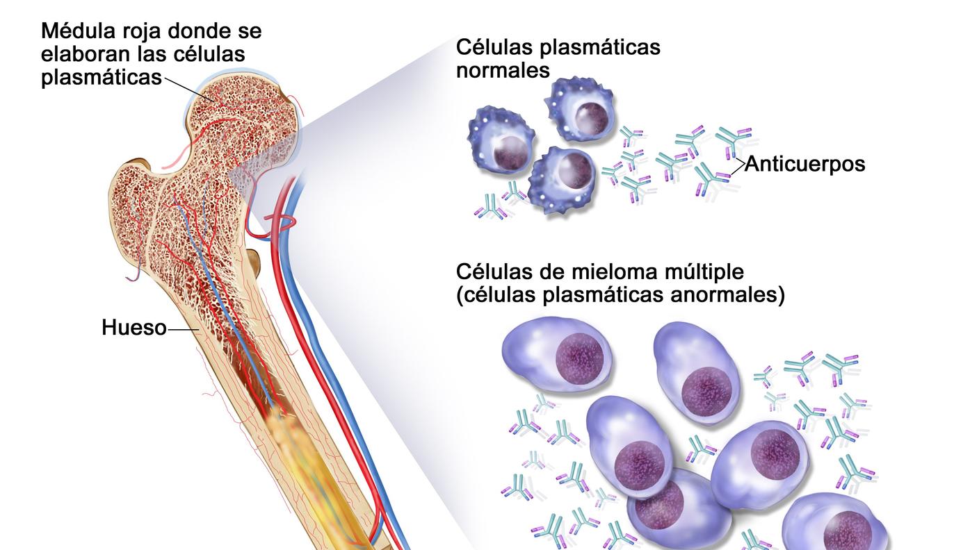 en la ilustración, se muestran células plasmáticas normales, células de mieloma múltiple (células plasmáticas anormales) y anticuerpos. También se muestra la médula roja en el hueso, en donde se elaboran las células plasmáticas.