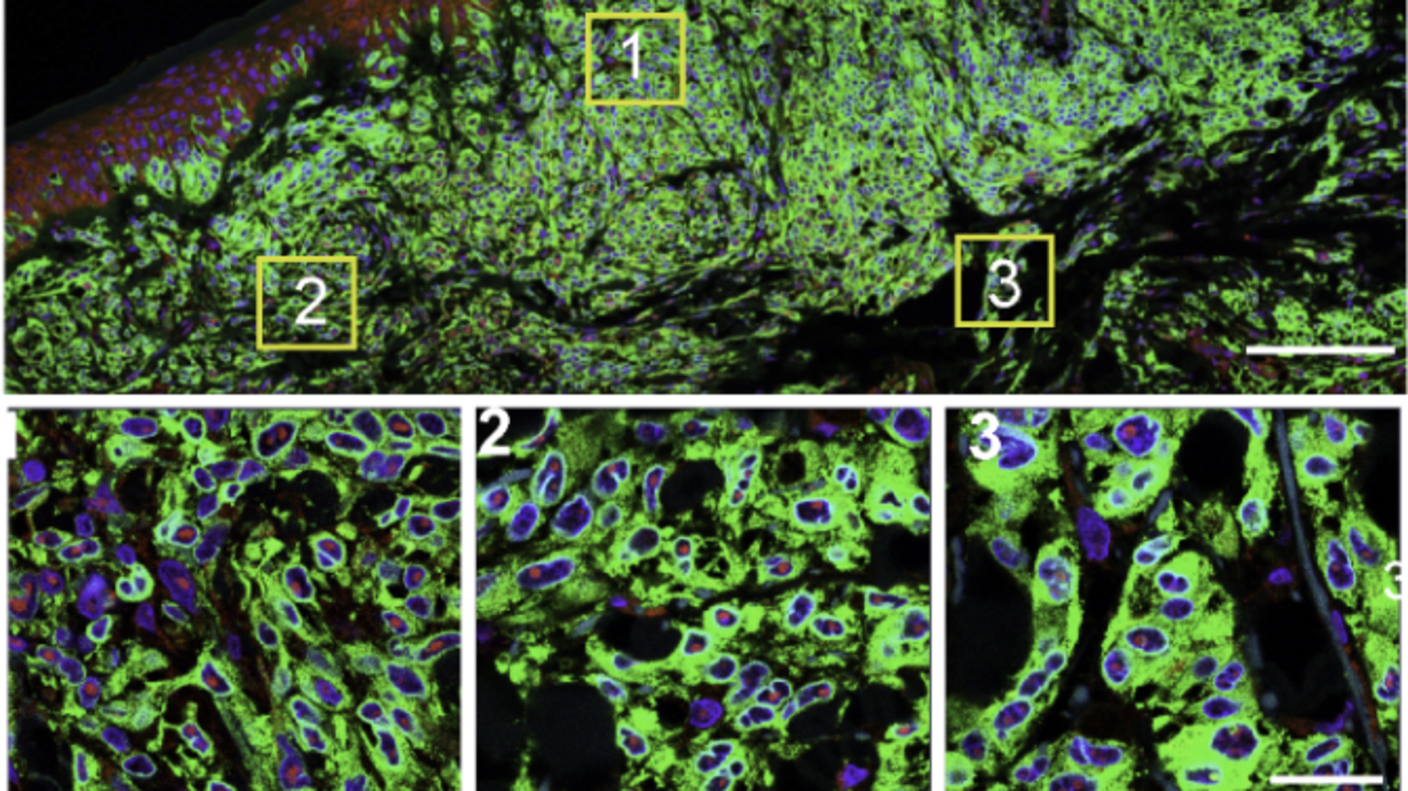 A microscopic image of melanoma cells, highlighting the androgen receptor in cell nuclei. The top panel displays a broad view with green, blue and black areas. Three yellow boxes labeled 1, 2, and 3 indicate areas of interest. The bottom panel provides magnified views of these areas, showing detailed cellular structures.
