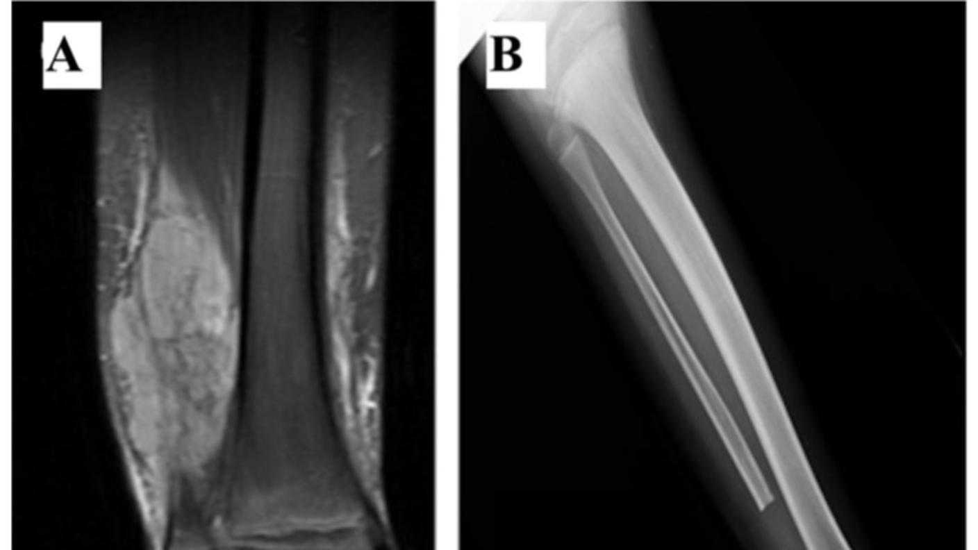 Side-by-side x-ray images. The left image is a close up of a fibula with a large tumor and the x-ray image itself is in shades of dark grey. The right image shows a lower leg with no tumor; the x-ray image is lighter grey and white compared to the left image.