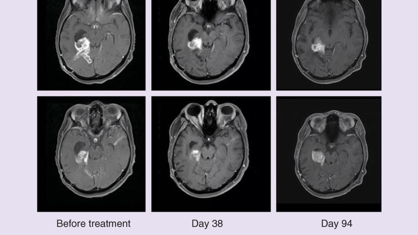 MRI scans of BRAF-positive brain tumors after dabrafenib and trametinib treatment.