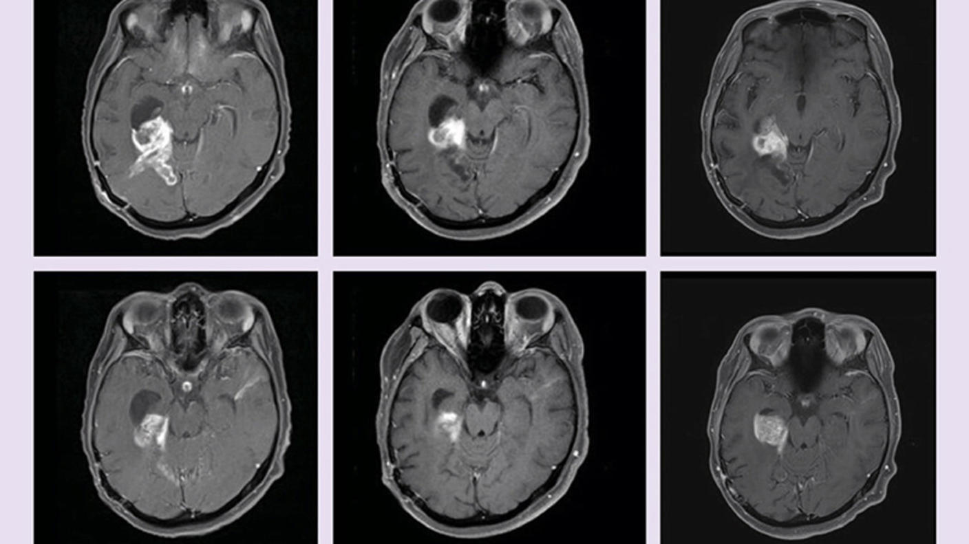 Imágenes por resonancia magnética de dos personas que tienen tumores de encéfalo con&nbsp;BRAF tratados con dabrafenib y trametinib (paciente 1, arriba; paciente 2, abajo).