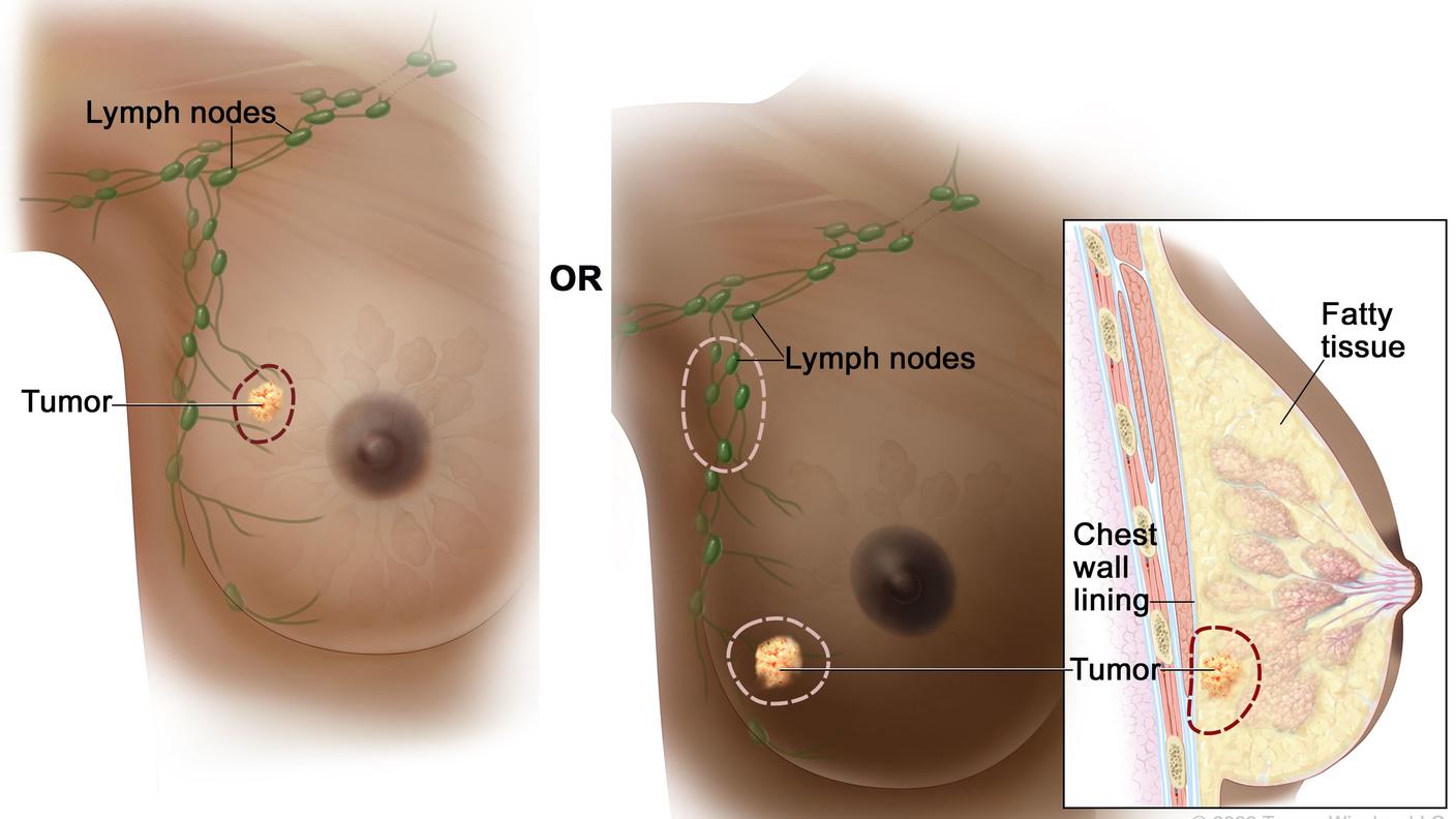 Illustrations of two forms of breast-conserving surgery