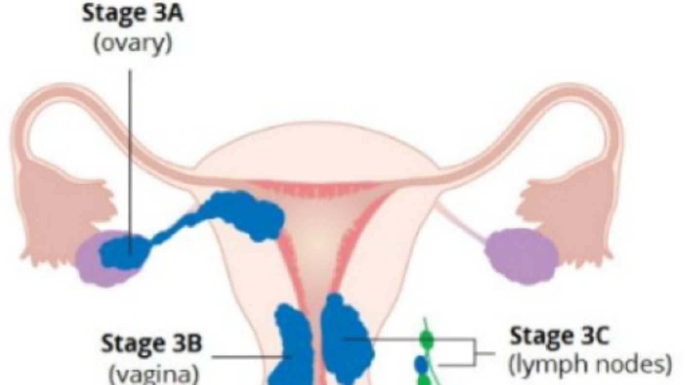 Anatomic illustration of stage 3a, 3b, and 3c endometrial cancer 