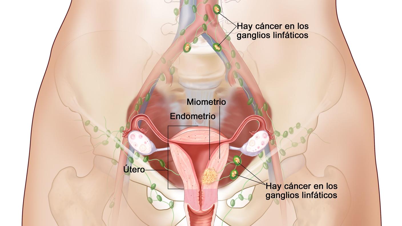 El dibujo muestra un cáncer de endometrio en estadio IIIC, en una sección transversal del útero, el cuello uterino, las trompas de Falopio, los ovarios y la vagina.