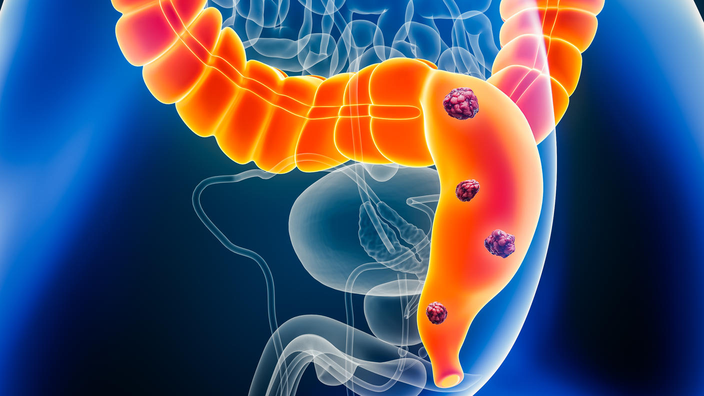 A 3-D illustration of anatomy in the lower abdomen of a male showing tumors in the colon and rectum.