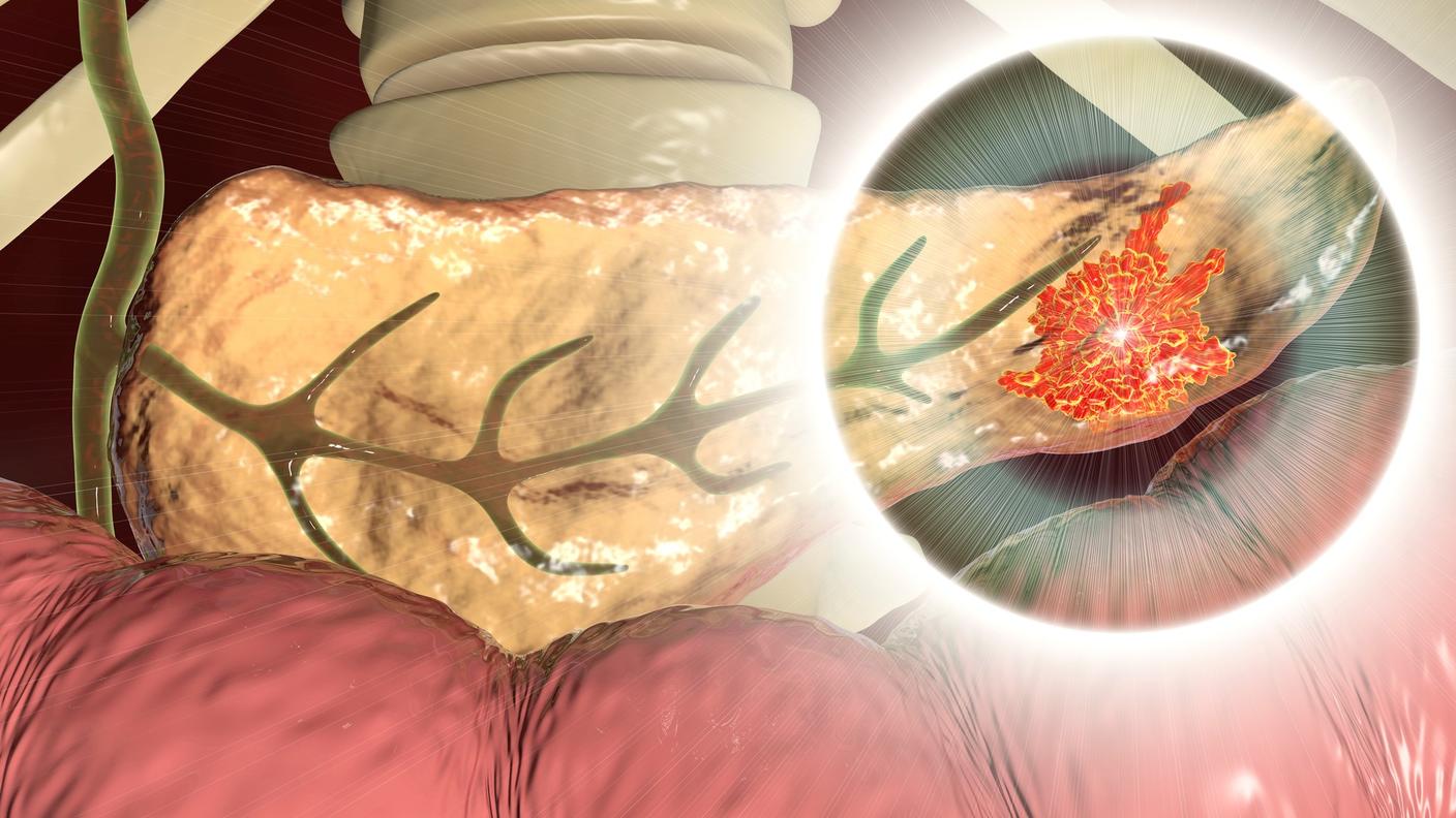 An illustration of a tumor in the pancreas