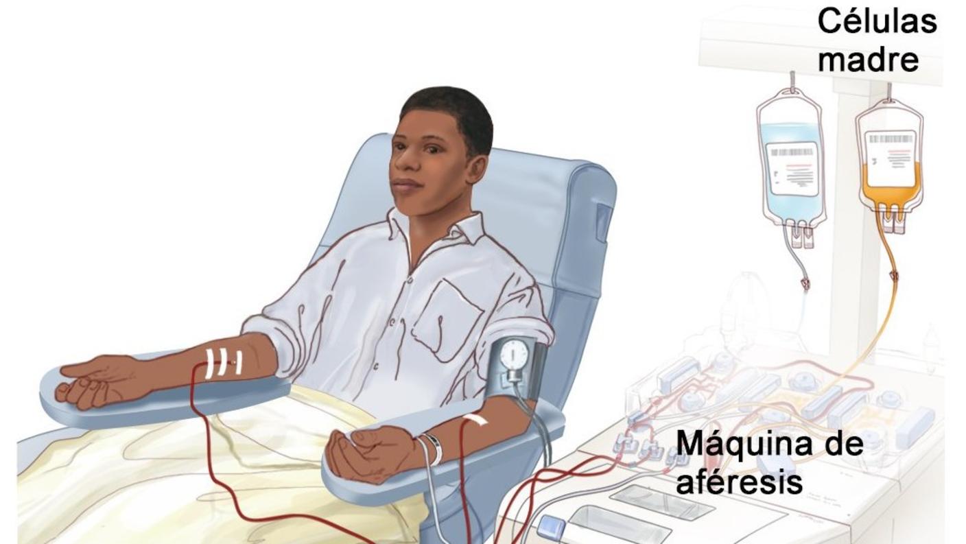Ilustración de un hombre joven que recibe aféresis para obtener células madre