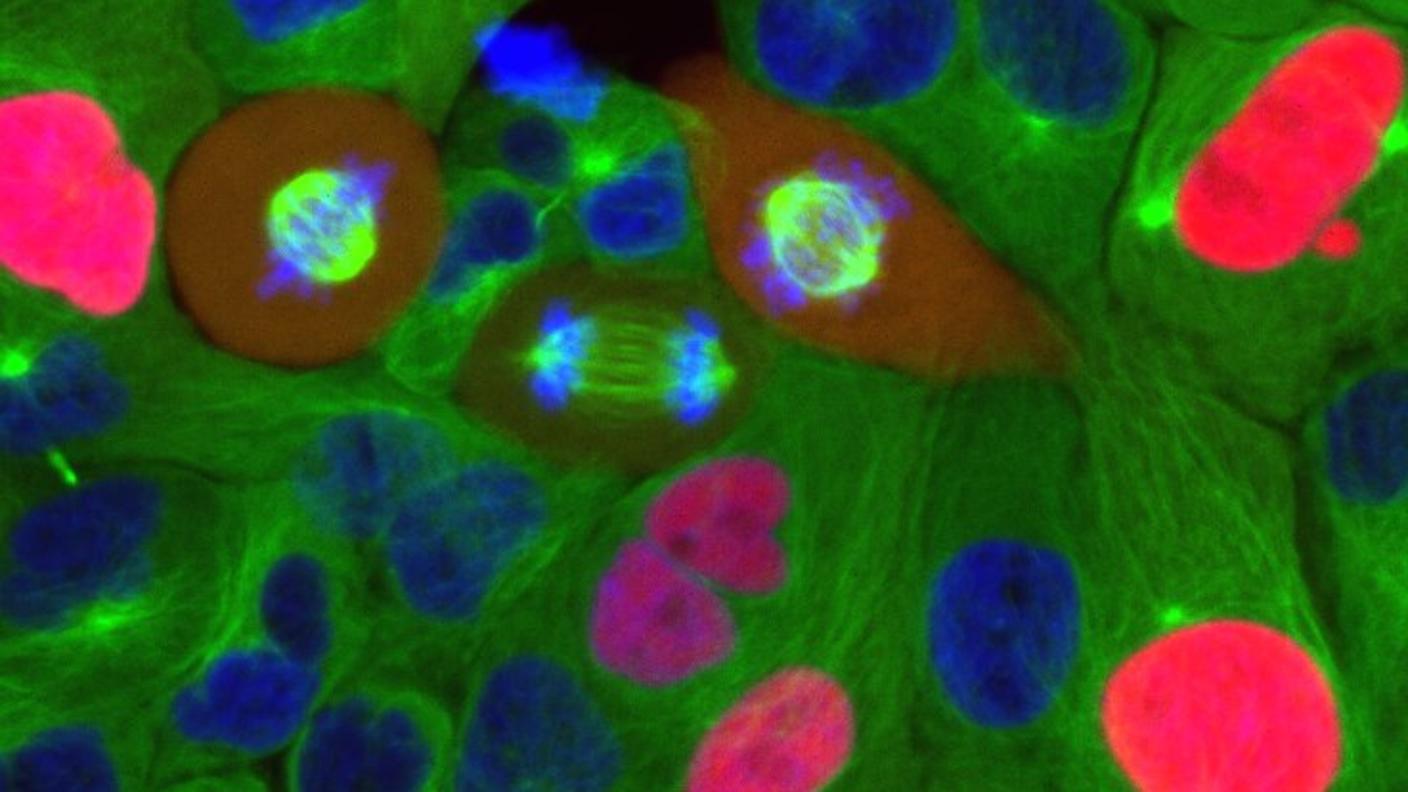 Microscope image of breast cancer cells in the process of dividing.