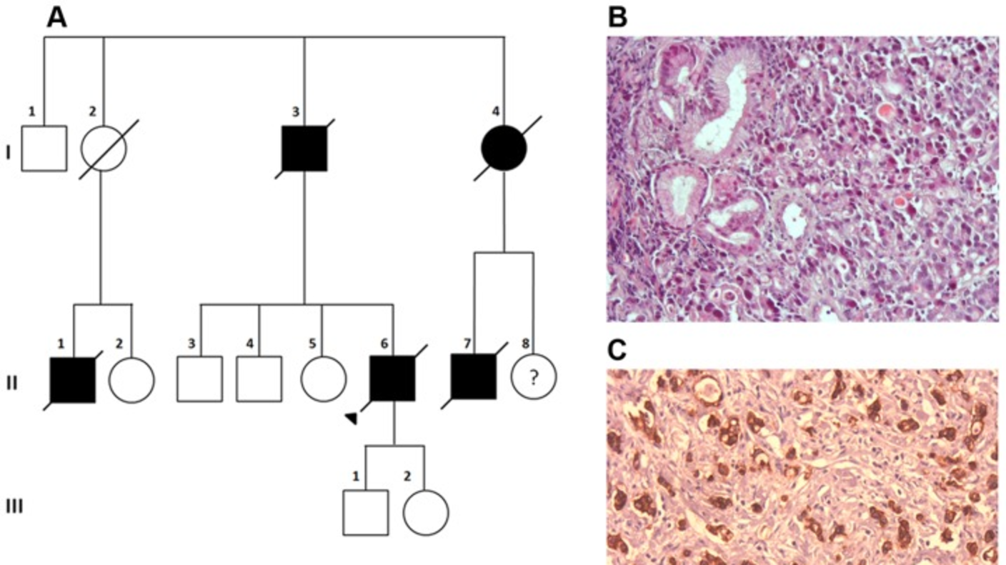 A three-part image. Part A shows a family pedigree. Parts B and C are pathology images of gastric cancer.