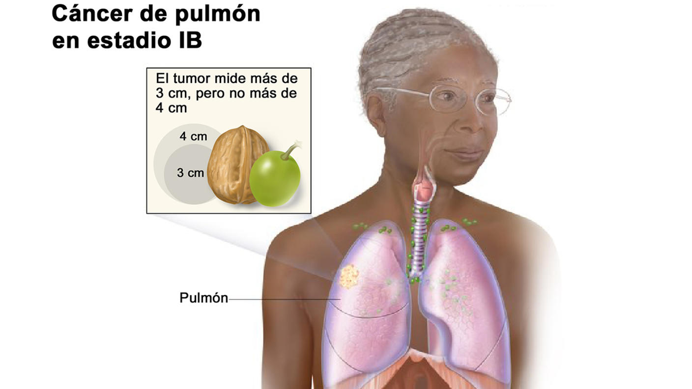 Ilustración del cáncer de pulmón en estadio 1B.