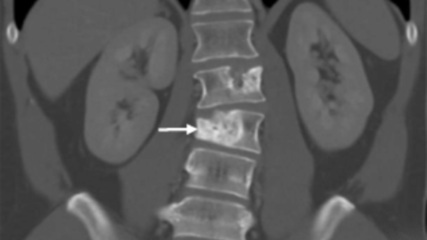 A CT scan showing a metastatic tumor embedded in a spinal vertabrae