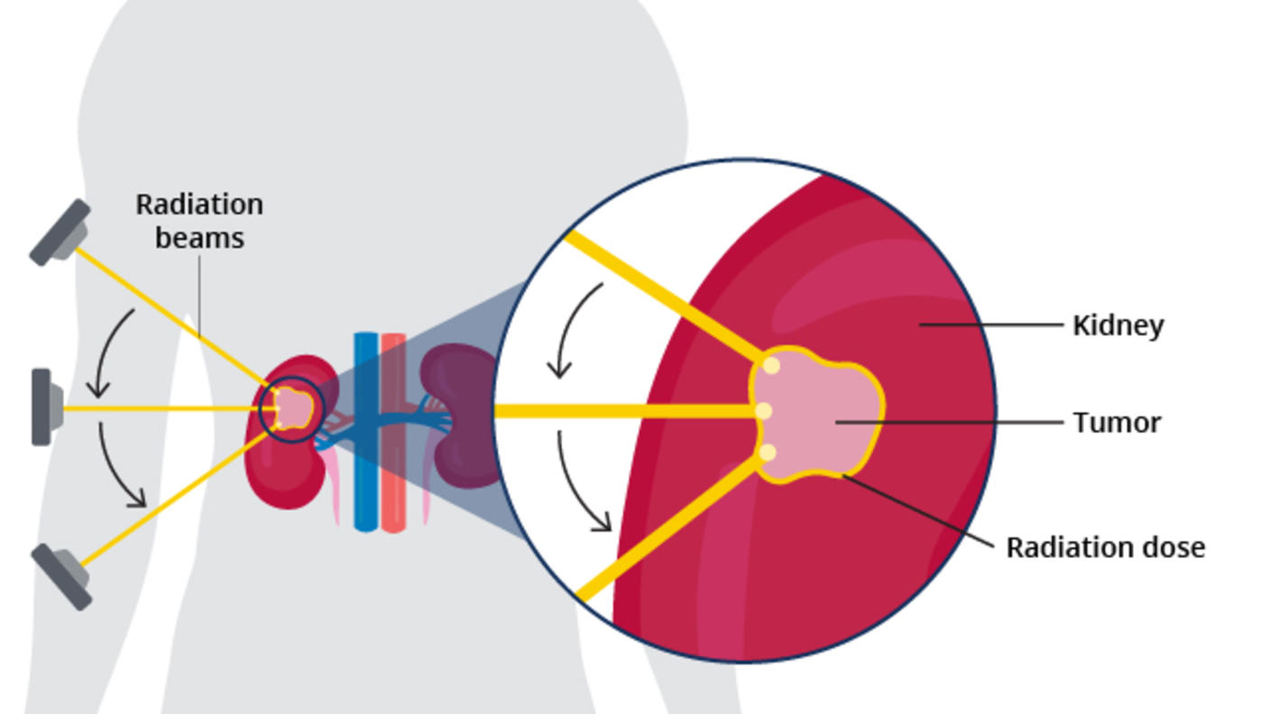 An illustration showing multiple radiation beams targeting a tumor in a kidney.