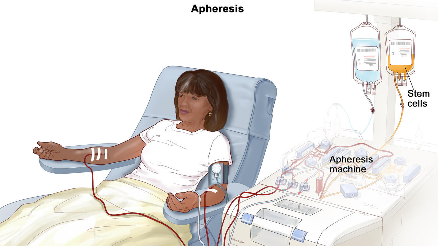 Woman sits in chair attached to an apheresis machine. The needle in one arm removes blood where it flows into the apheresis machine. Then, another needle carries blood from the apheresis machine into her other arm.