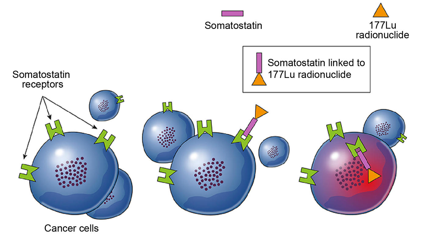 Somatostatin linked to 177Lu receptors on cancer cells.