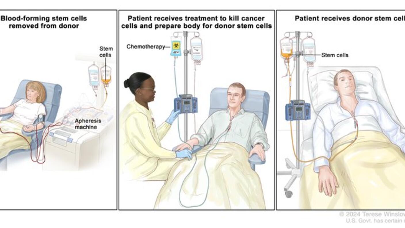 3 panels showing the stem cell transplant process 
