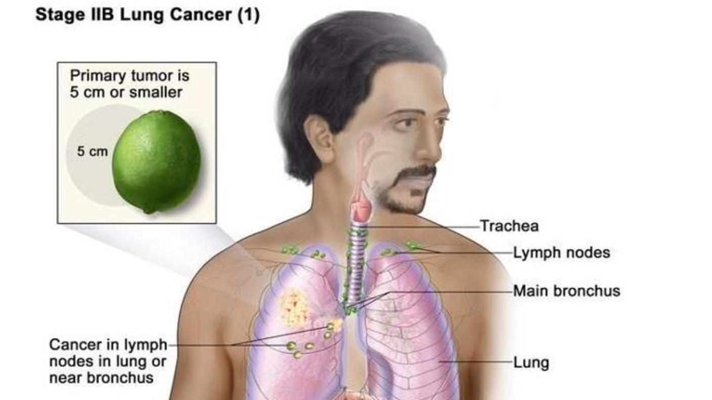 Illustration of a male figure showing the anatomy of the lungs with stage 2B lung cancer