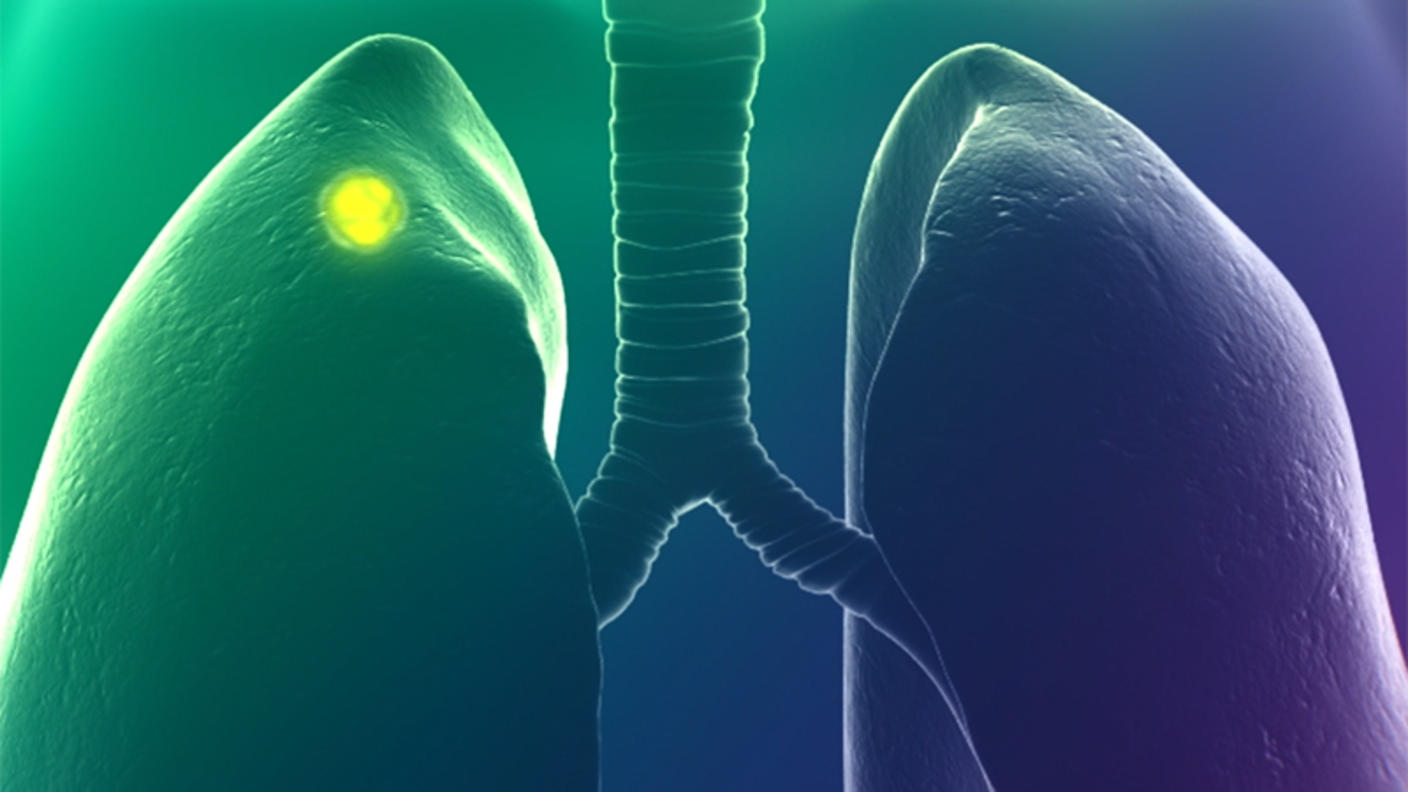 A three-dimensional rendering of the human body with a lung tumor lit up in green.