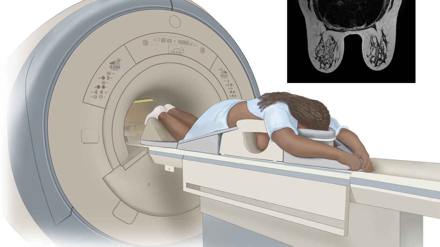 MRI of the breast; drawing shows a person lying face down on a narrow, padded table with their arms above their head. The person’s breasts hang down into an opening in the table. The table slides into the MRI machine, which takes detailed pictures of the inside of the breast. An inset shows an MRI image of the insides of both breasts.