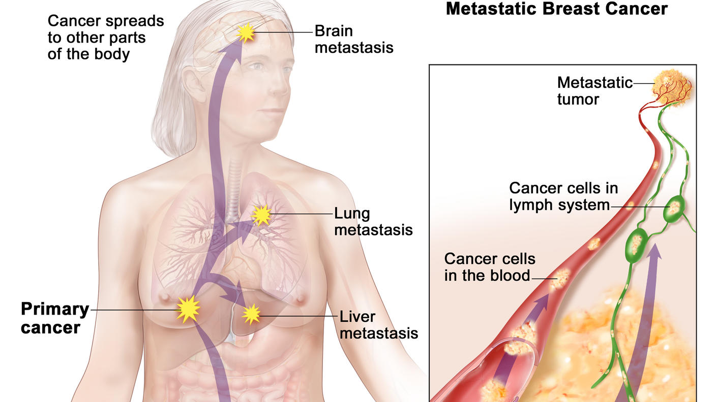 Drawing of a female body shows where primary breast cancer may spread, including the brain, lungs, liver, and bones. An inset shows a close-up view of cancer cells spreading from the breast through the blood and lymph system to another part of the body, to form a metastatic tumor.