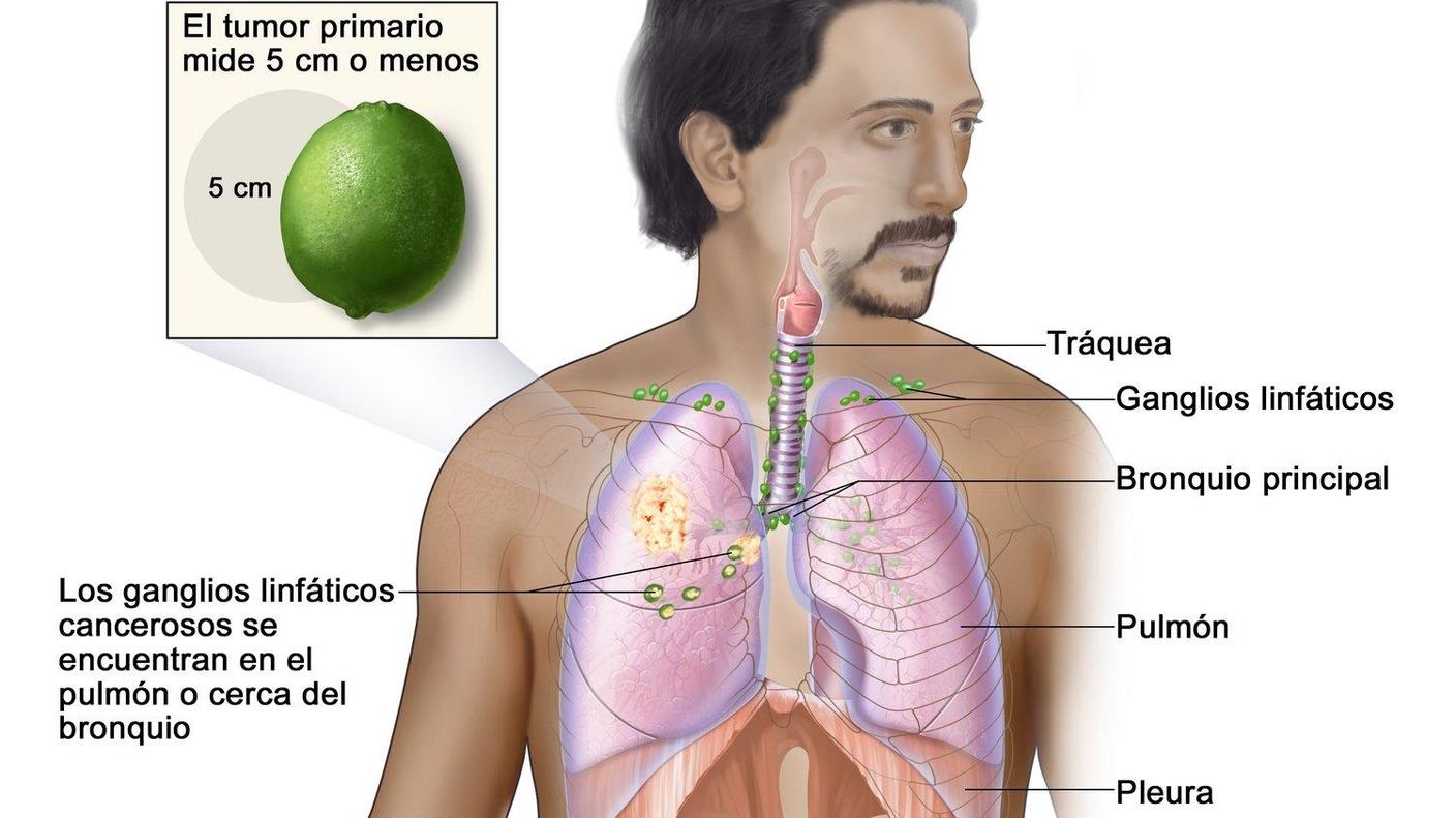 Cáncer de pulmón en estadio IIB. 
