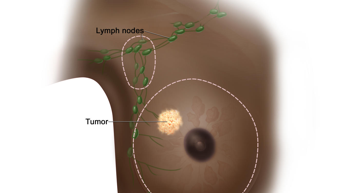 Total (simple) mastectomy; drawing shows removal of the whole breast and some of the lymph nodes under the arm.