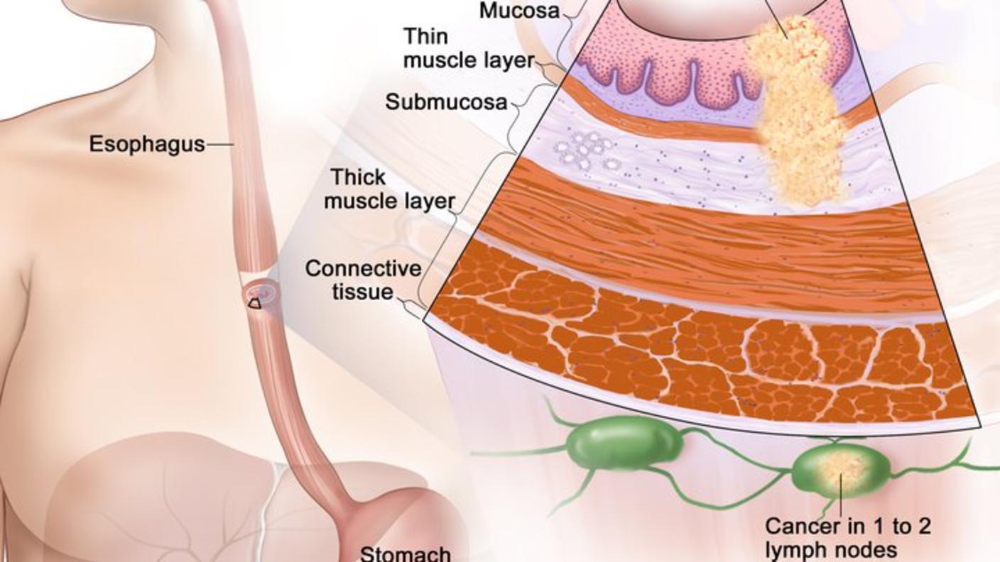 anatomic illustration of stage 2b esophageal cancer, with pop out of cancer cells in nearby lymph nodes 